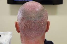 DHI Hair Transplant