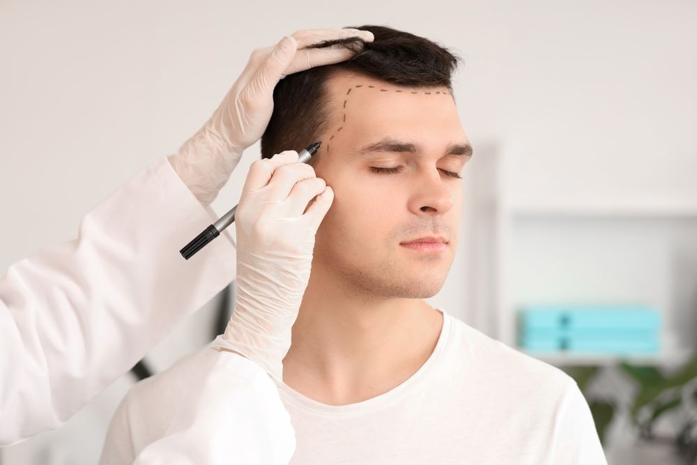 Hair Transplant (FUE)